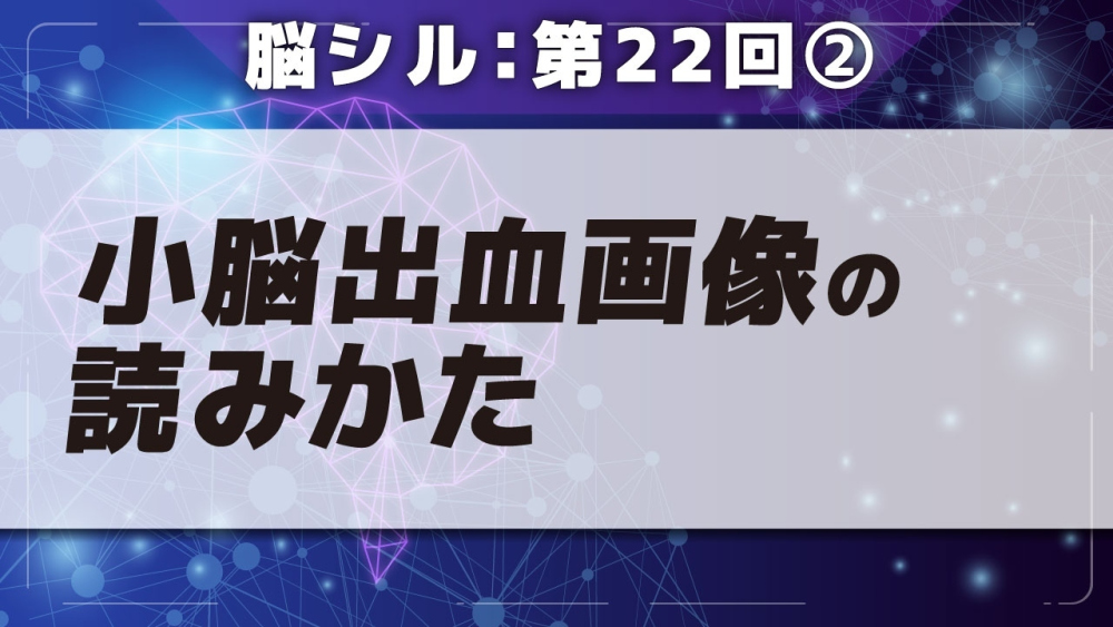 脳シル【第22回】その他の脳内出血の脳画像読影 Part②小脳出血画像の読みかた